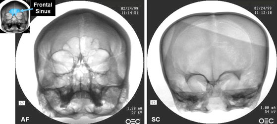 Front X Rays