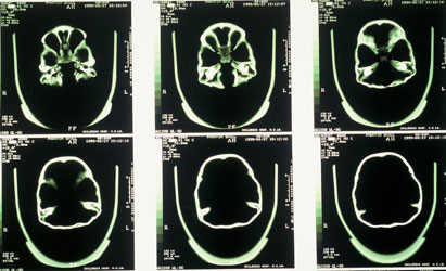 CAT Scan